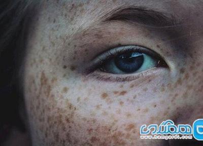 کک و مک های پوست از کجا می آیند؟